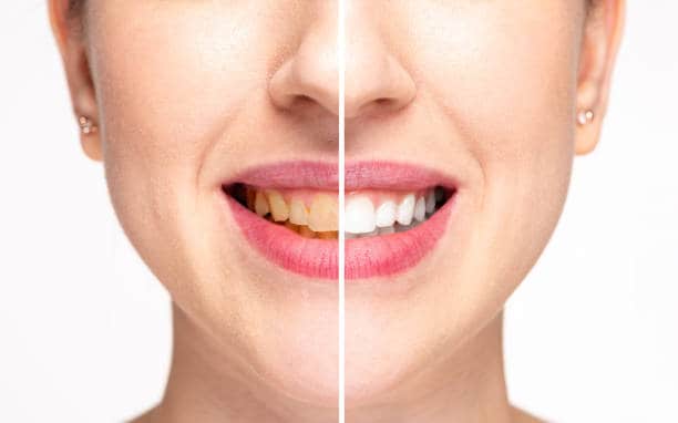 Teeth Whitening Milton Keynes Leicester