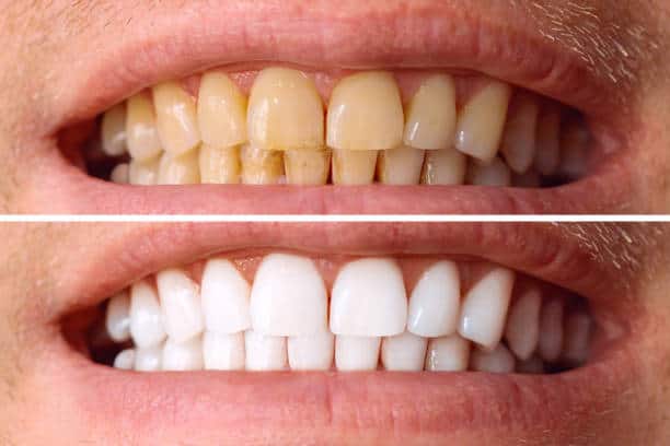 Laser White For Ever Bright – Get a Brighter, Whiter Smile with LA Teeth Whitening Leicester