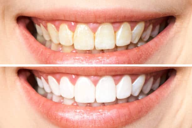 Achieve a Dazzling Smile for Your Special Day: A Guide to Wedding Teeth Whitening Leicester