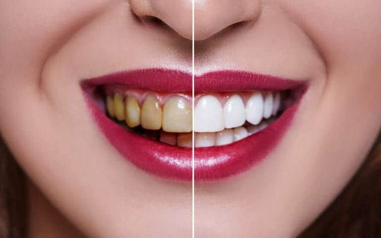 Teeth Whitening Ascot Windsor Leicester