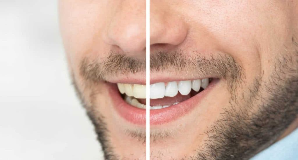 Teeth Whitening Bedfordshire Leicester