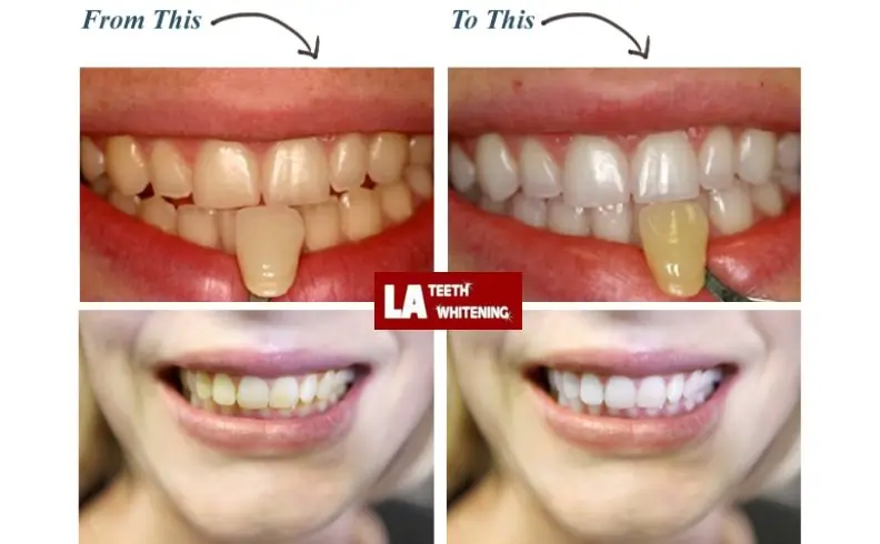 I Don't Want My Teeth Too White Leicester