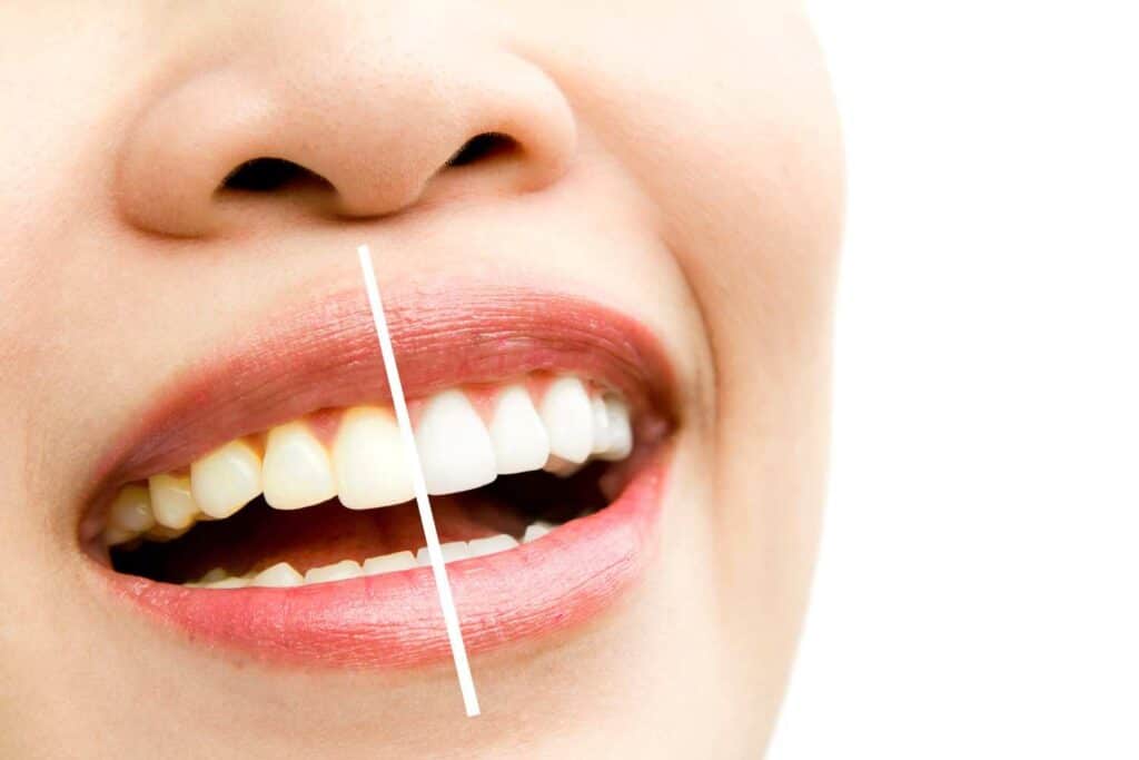 Can I Maintain My New Smile If I&rsquo;m a Coffee or Red Wine Lover Leicester